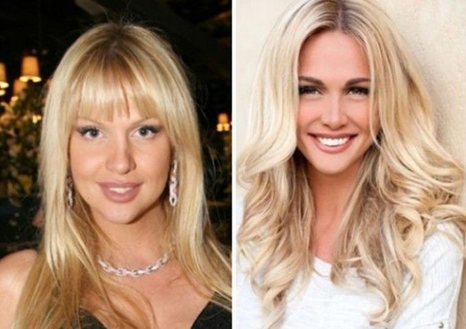 10 знаменитостей которым пластика явно пошла на пользу