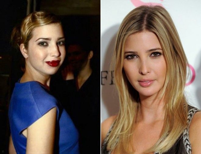 10 знаменитостей которым пластика явно пошла на пользу